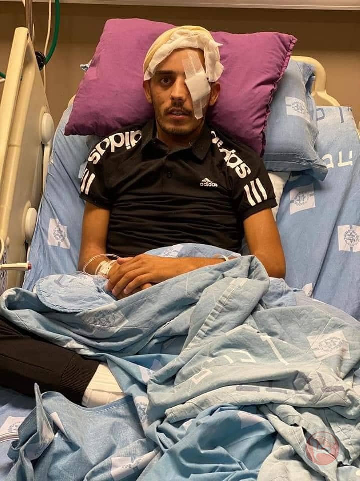 فقد عينه في الأقصى  واعتقل - الاحتلال يحول جريحا للحبس المنزلي 