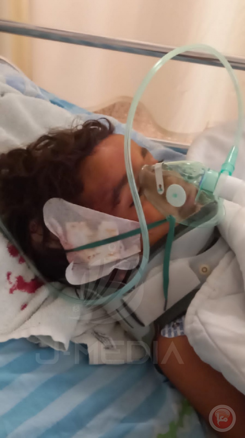 اصابة 9 اشخاص بينهم طفل حالته خطرة نتيجة اعتداء المستوطنين في المفقرة  جنوب الخليل
