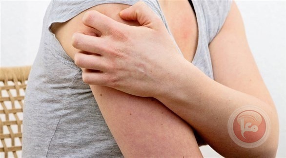 أعراض جلدية قد تنذر بالكورونا