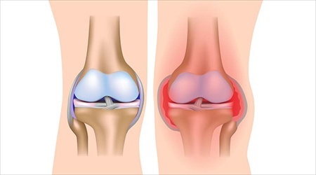 علاج تيبّس المفاصل