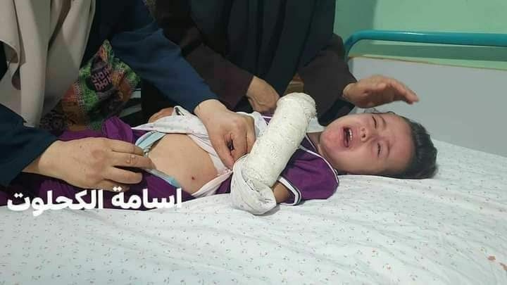 الطفلة المصابة جراء قصف الاحتلال.. تصوير اسامة الكحلوت
