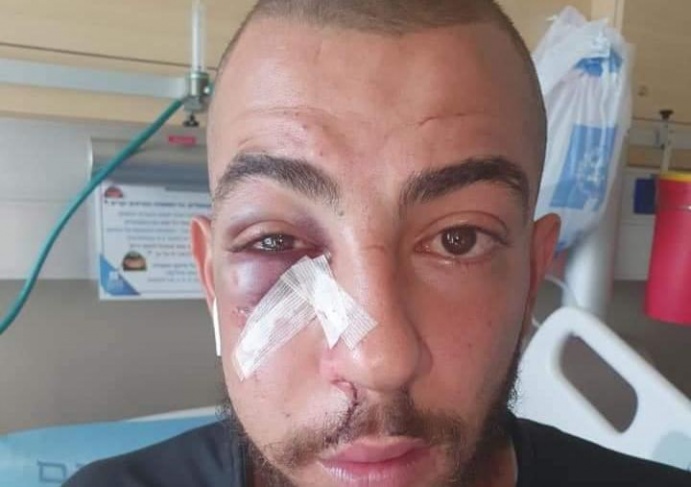 إصابة شاب بجروح وكسور إثر اعتداء الاحتلال عليه في القدس