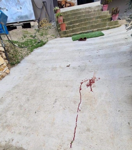 إصابة طفلة في هجوم للمستوطنين جنوب نابلس (صور)