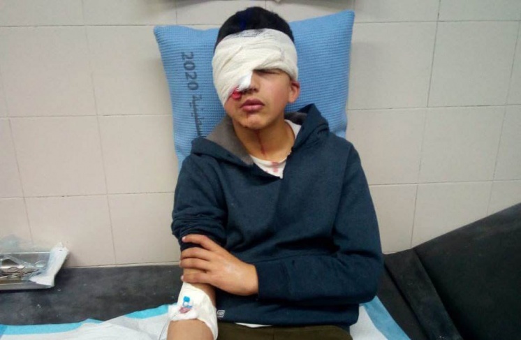 شاهد- اصابة طفل برصاص مطاطي في عينه بالخليل