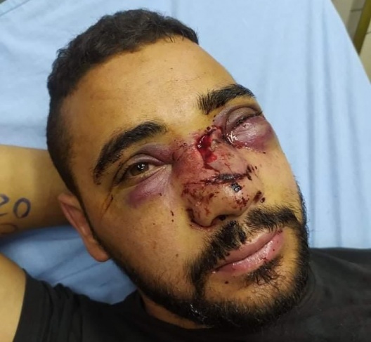  الاحتلال يتسبب بتشوه في وجه الجريح أبو زيتون وضرر كبير بعينه