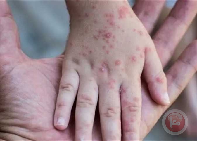 بسبب المهرجانات والحفلات.. الصحة العالمية تحذر من تفشي أوسع لجدري القرود