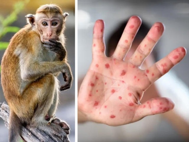 الصحة العالمية توضح حقيقة  التطعيم الإجباري ضد جدري القردة