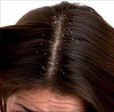 تسبب إصابات وحروق- تحذير من حيلة مضادة لقشرة الشعر انتشرت عبر &quot;تيك توك&quot;