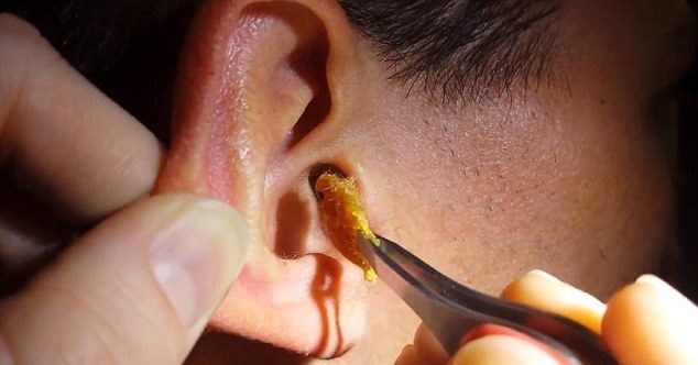 باحثون يحذرون من شمع الأذن.. يؤثر على حاسة السمع