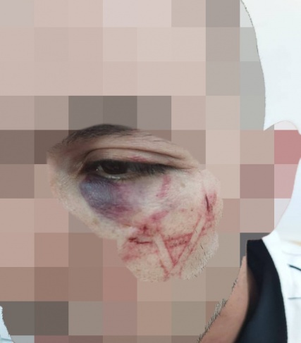 The occupation police admits that its members dug the “Star of David”  On the face of a Palestinian youth!  (photo)