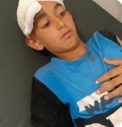A child suffered a skull fracture after being hit by rubber bullets