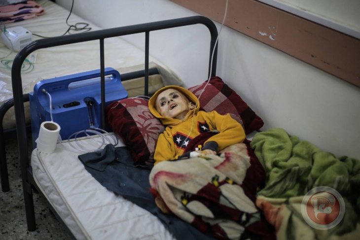 غزة: 112 طفلا يدخلون المستشفيات يوميا بسبب سوء التغذية