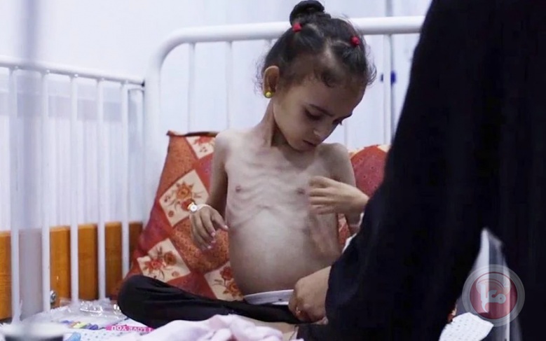 خمسة ضحايا جدد نتيجة الجوع في قطاع غزة يرفع الحصيلة إلى 162 