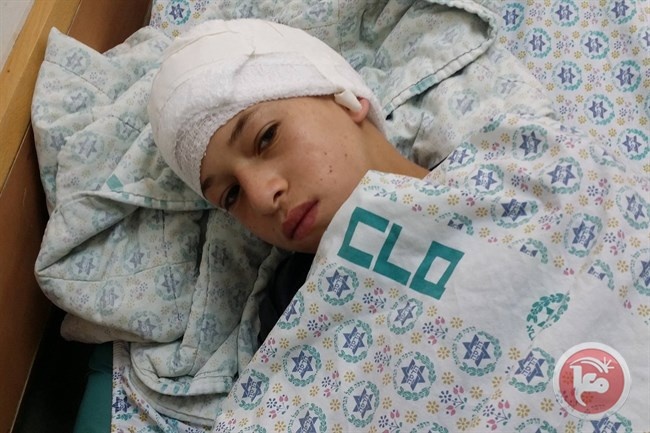 اصابة طفل مقدسي بعيار مطاطي في رأسه
