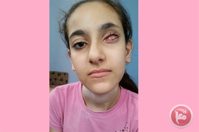 الطفلة اناغيم للرئيس: عيني بحاجة للعلاج