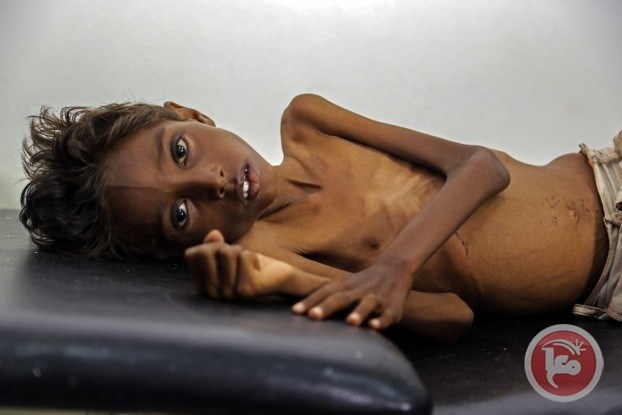 اليونيسف: 1.4 مليون طفل قد يموتون بسبب الجوع