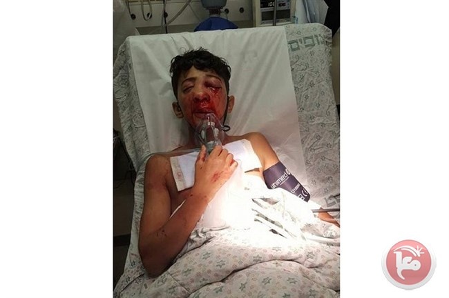 اصابة طفل بعيار مطاطي في وجهه بالعيسوية