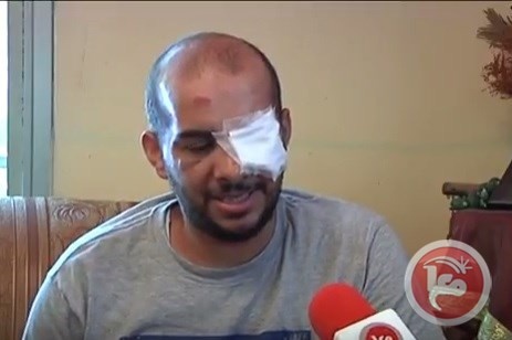 رصاصة مطاطية تُفقد محمد أبو تاية عينه اليسرى