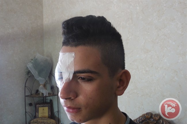 أطفال مهددون بفقدان بصرهم بسبب رصاص الاحتلال الإسرائيلي
