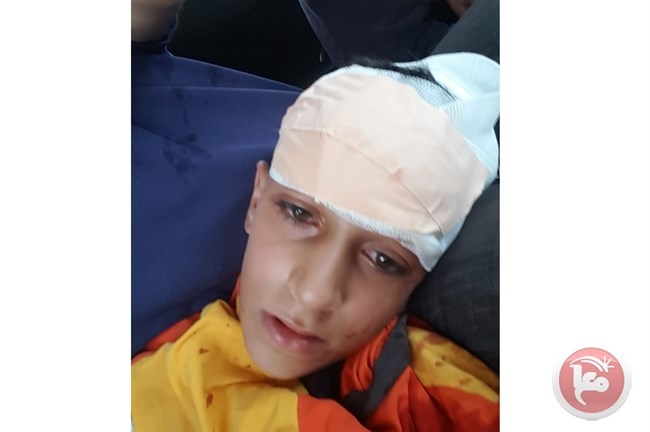 اصابة طفل برصاص الاحتلال في كفر قدوم