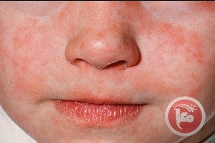 منظمة الصحة العالمية تحذر من وباء الحصبة