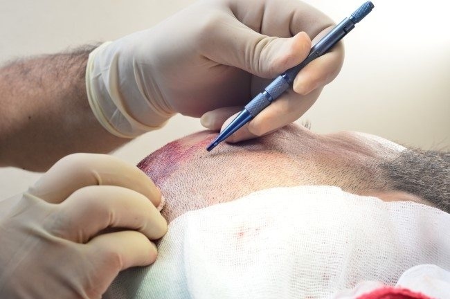 زراعة الشعر بتقنية الاقتطاف