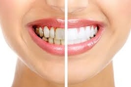 دراسة- تبييض الأسنان أخطر مما تتصور
