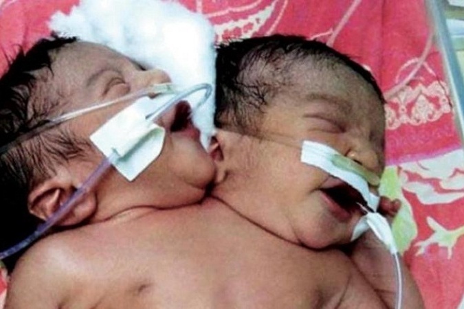 ولادة نادرة لطفل برأسين وقلب واحد في مصر