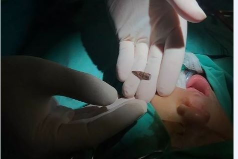 استخراج رصاصة اسرائيلية من رأس رضيعة في نابلس