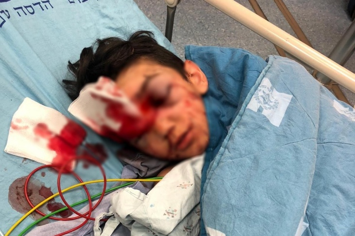 الخطر يتهدد عينه- اصابة طفل برصاص الاحتلال في العيسوية